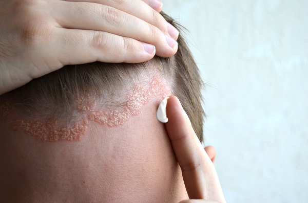 Can Scalp Psoriasis Cause Hair Loss