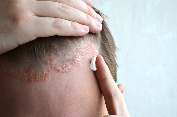 scalp psoriasis hair loss