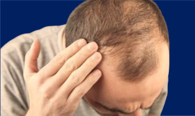 Can losing weight cause Hair loss?