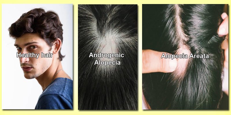 types-of-alopecia-hairdoc