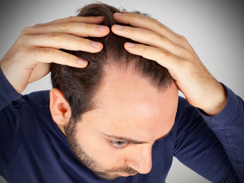 Hormonal Imbalances And Hair Loss Hairdoc Trichology Expert