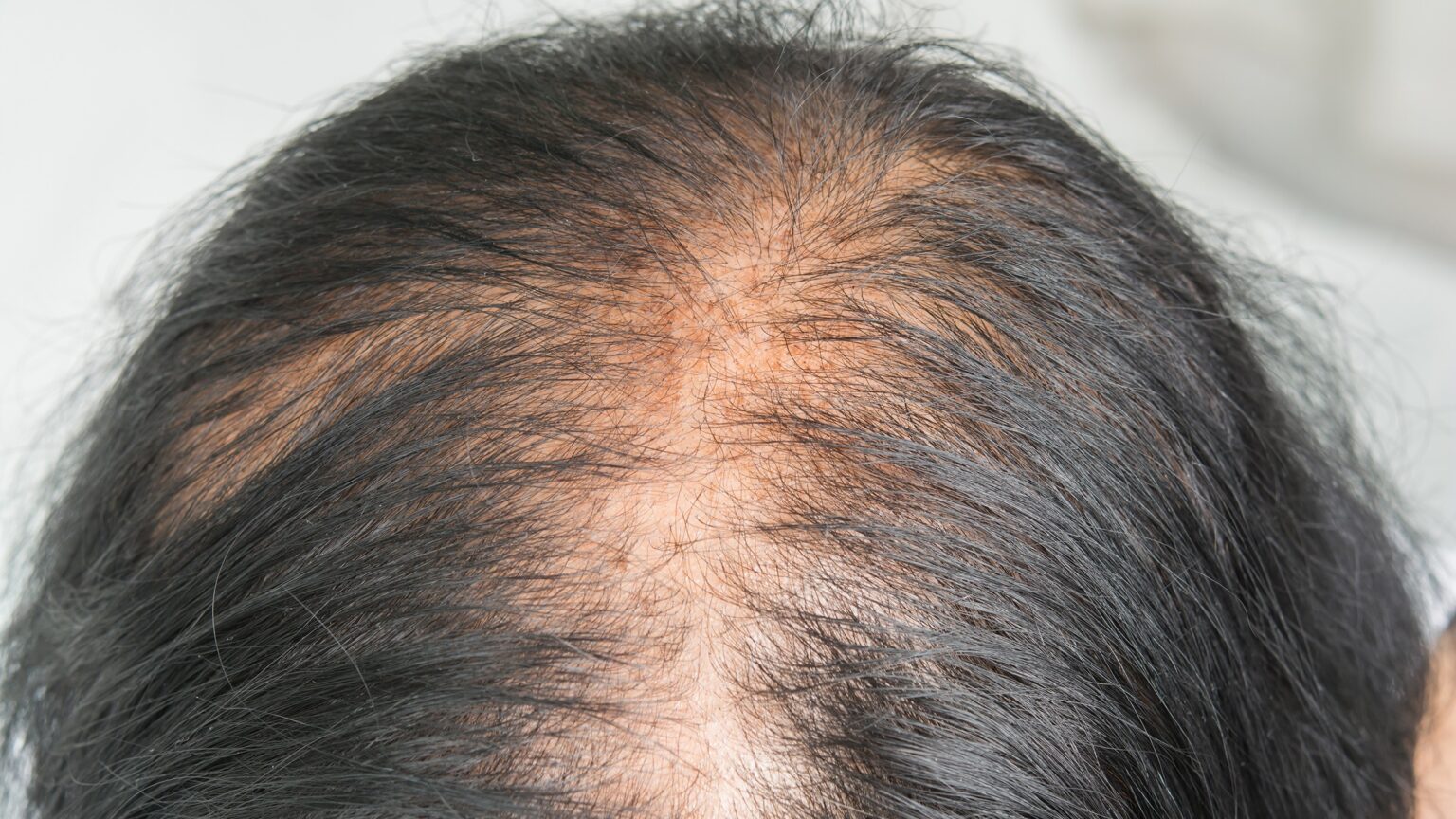 Early Stage Symptoms Of Hair Fall Hairdoc Trichology Expert