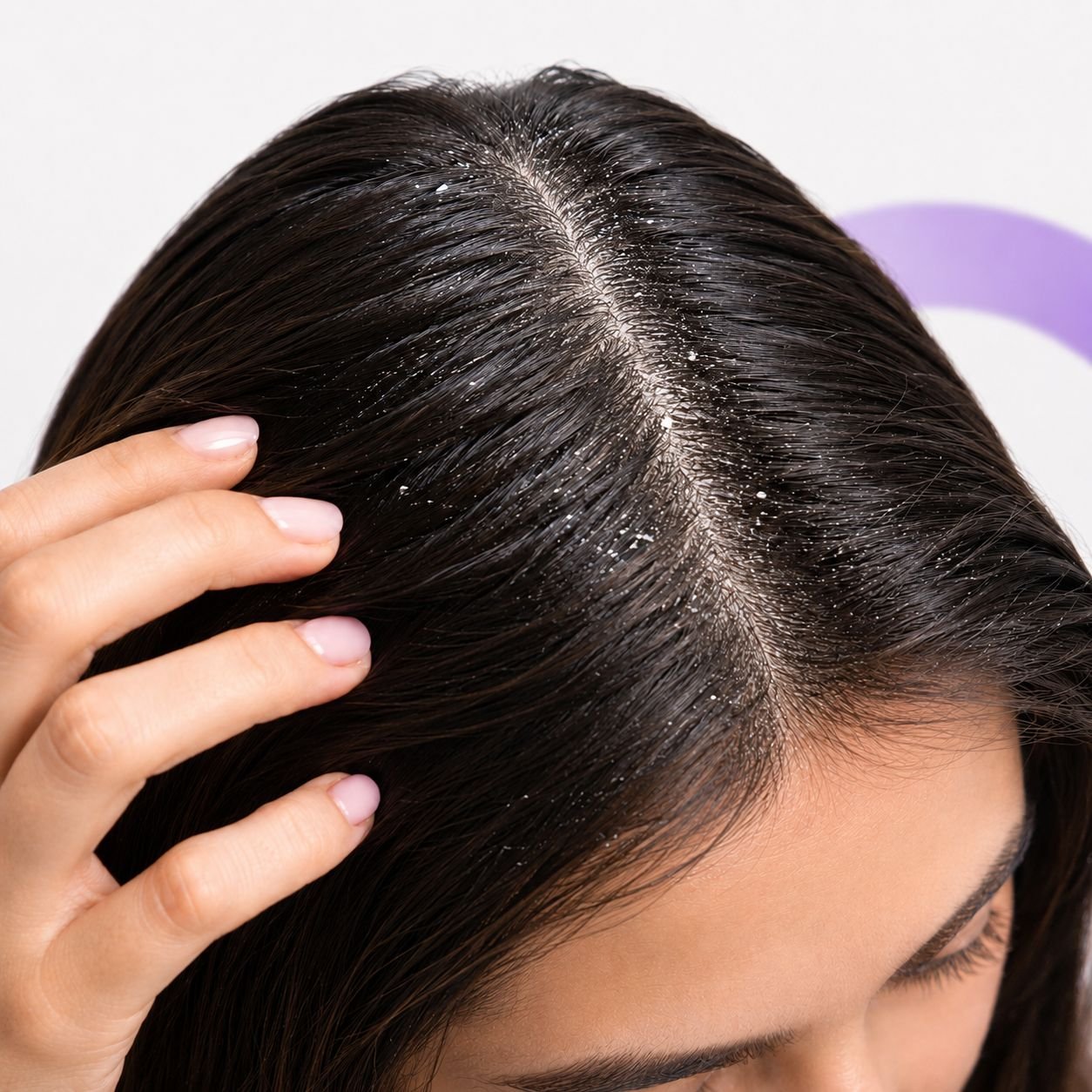 Dry scalp with white flakes