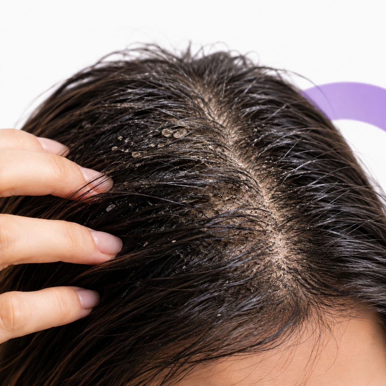 Poor scalp hygiene causing buildup